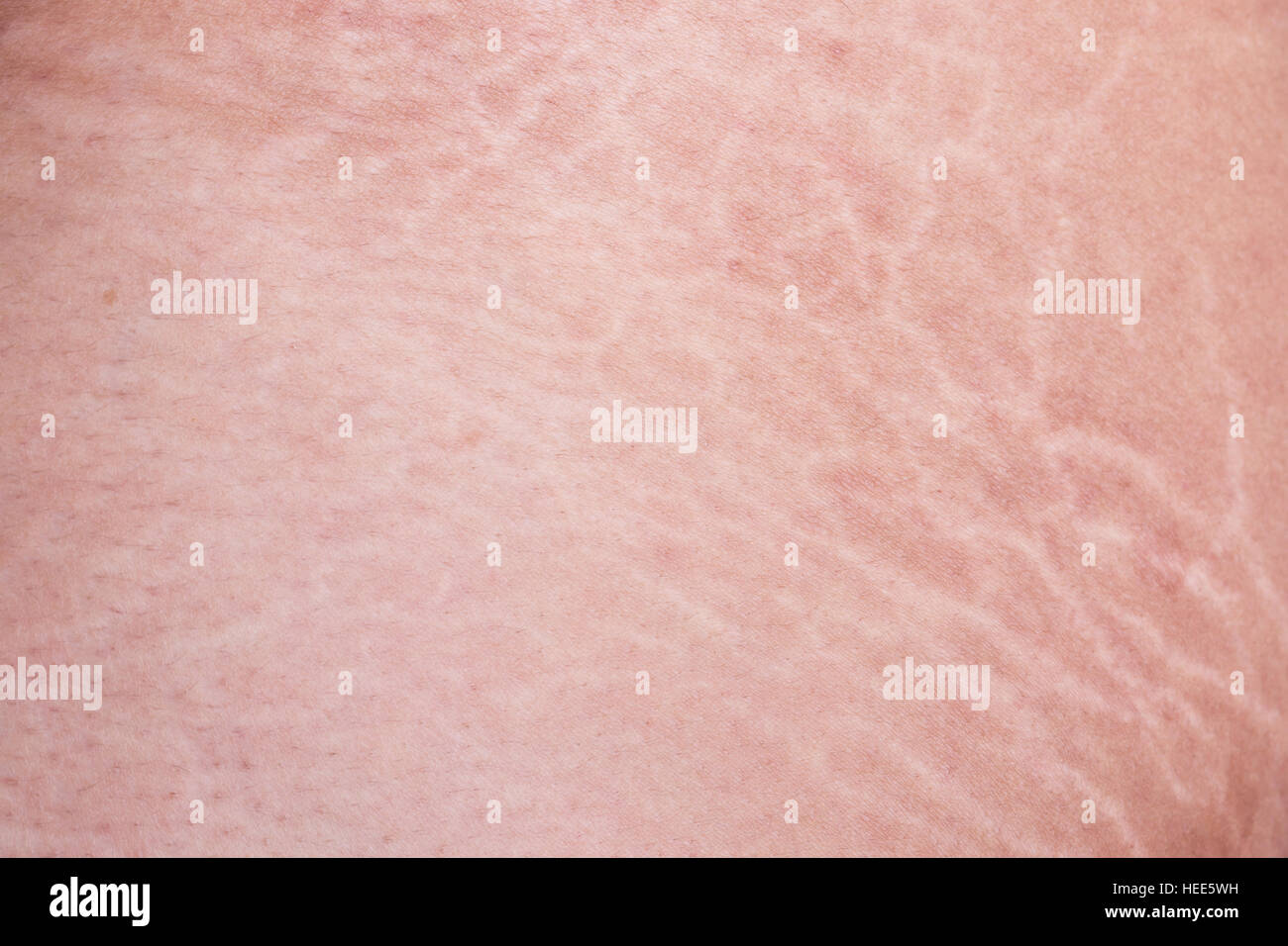 Macro stretch marks of skin on the thigh Stock Photo Alamy