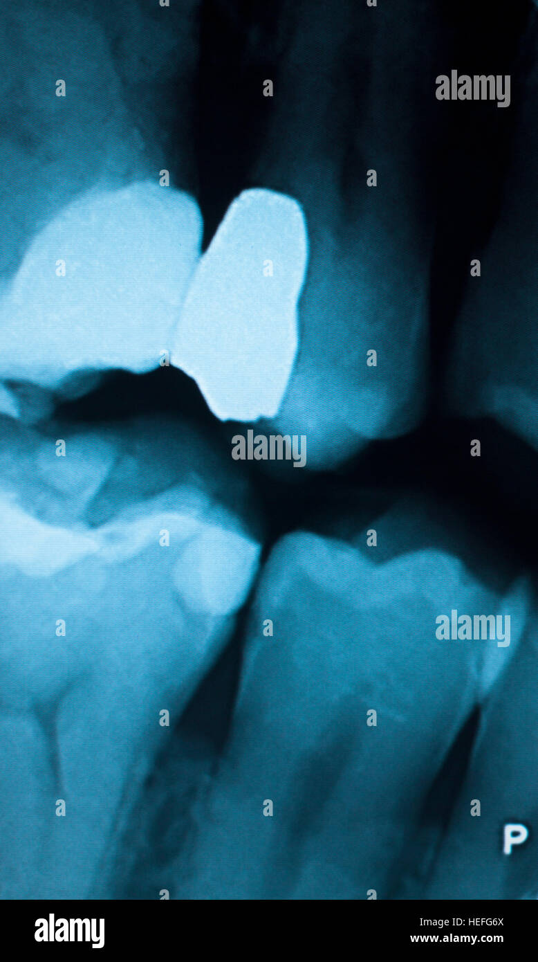 Tooth with filling dental xray closeup image showing teeth roots, gum