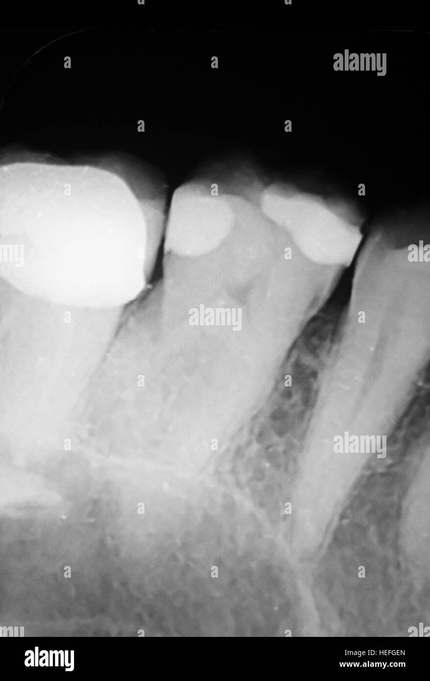 Tooth with filling dental xray closeup image showing teeth roots, gum