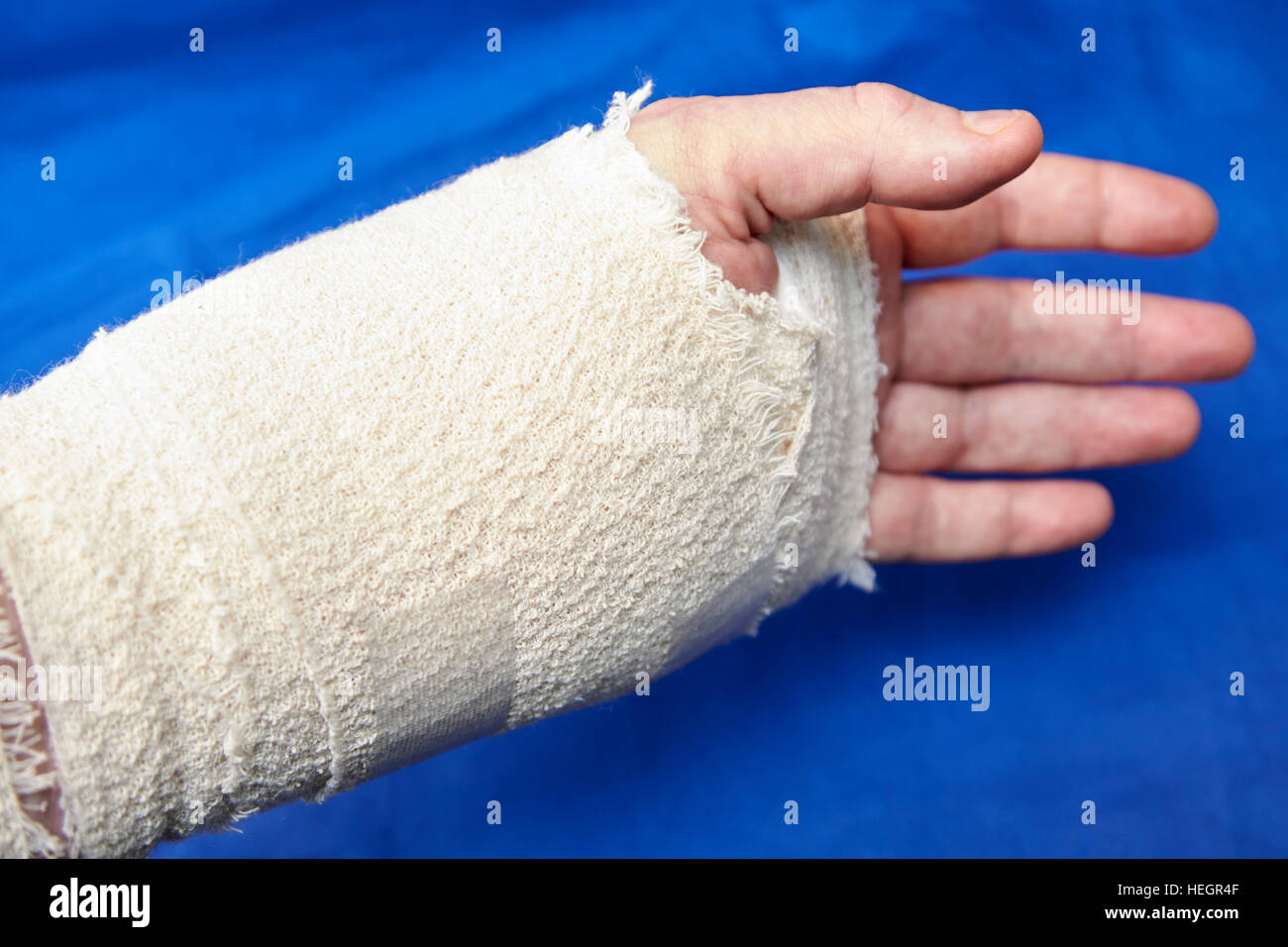 bandaged left hand after carpal tunnel injury surgery Stock Photo