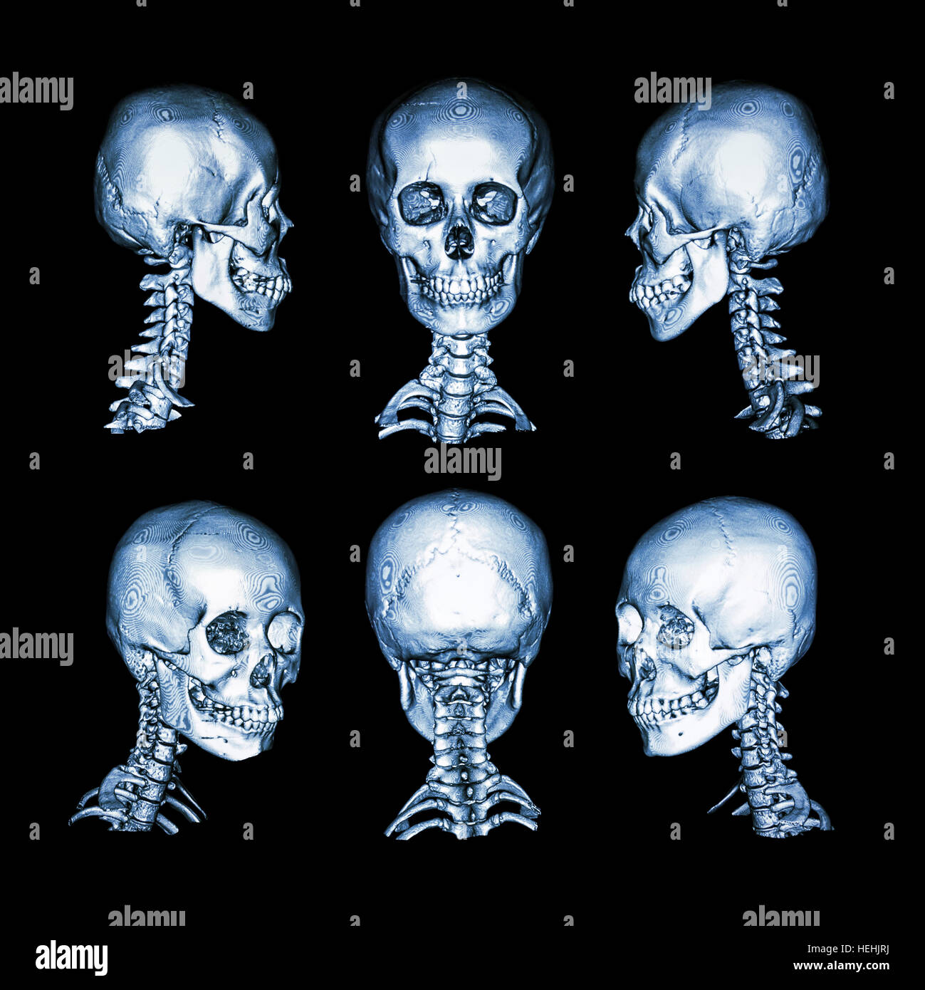 CT scan and 3D image . Normal human skull and cervical spine . all direction Stock Photo