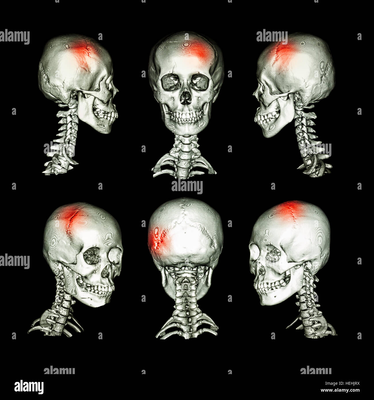 CT scan and 3D image of head and cervical spine . Use this image for stroke , skull fracture , neurological condition . Stock Photo