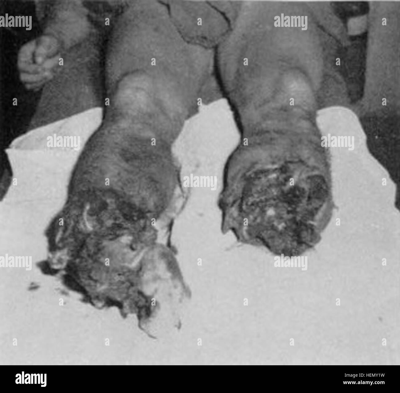 Amputation rehabilitation Black and White Stock Photos & Images - Alamy