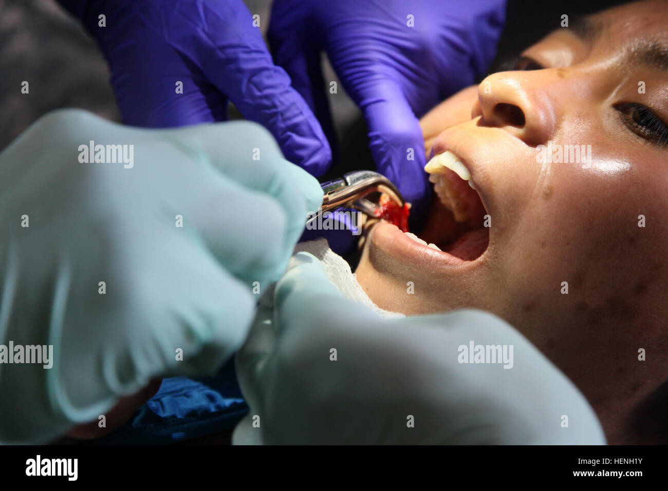 U.S. Army Soldiers of the Arizona Medical Detachment, perform a dental procedure on a Guatemalan woman at a Medical Readiness Training Exercise during Beyond the Horizon, Lomas Abajo, Guatemala, May 22, 2014. Beyond the Horizon is an annual exercise that embraces the partnership between the United States and Guatemala, to provide focused humanitarian assistance through various medical, dental, and civic action programs. (U.S. Army photo by Pfc. Christopher Martin/Released) Beyond The Horizon 2014, Guatemala 140522-A-GA303-065 Stock Photo