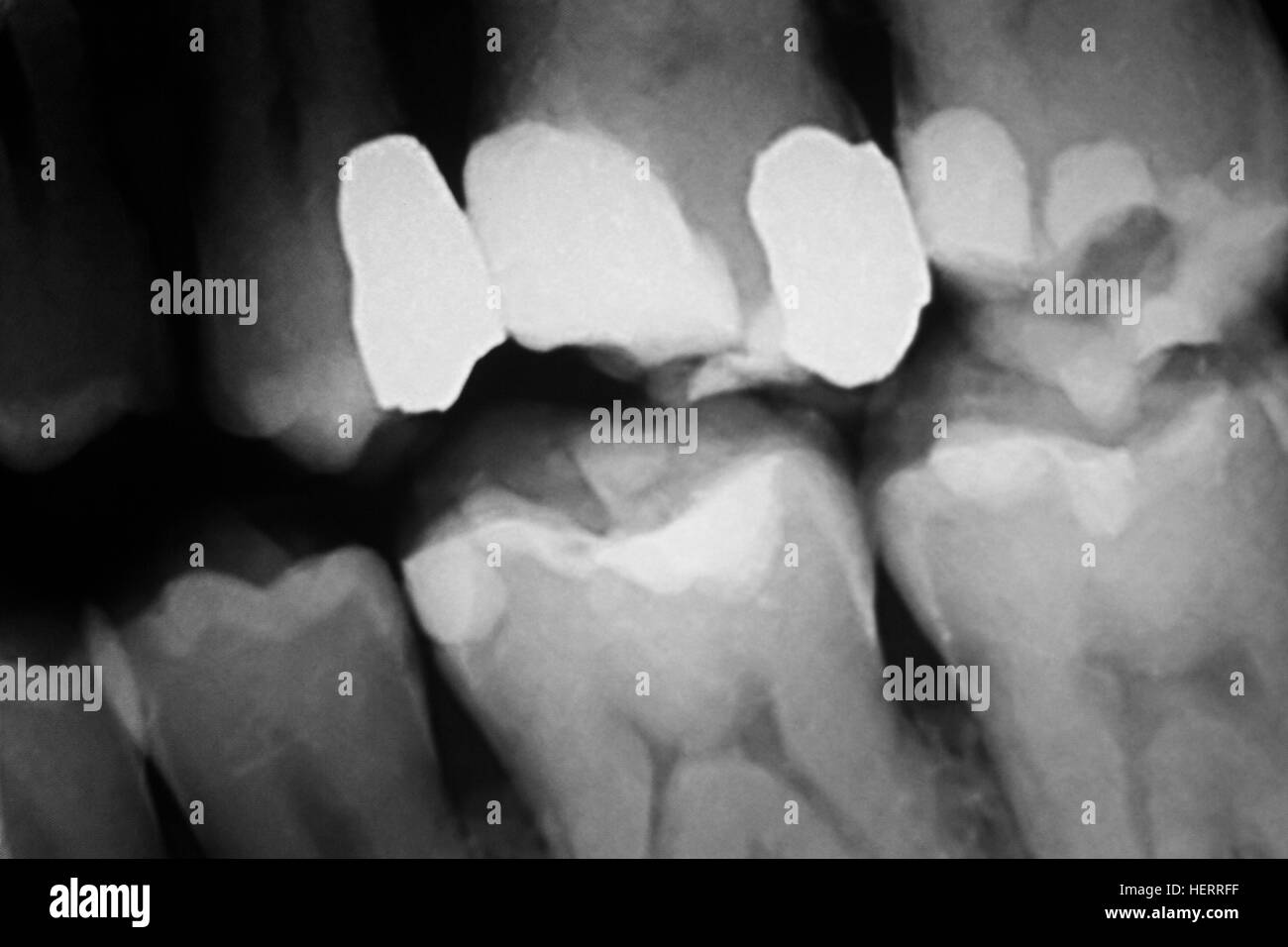 Tooth with filling dental xray closeup image showing teeth roots, gum
