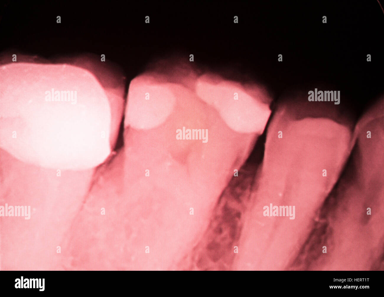 Tooth with filling dental xray closeup image showing teeth roots, gum