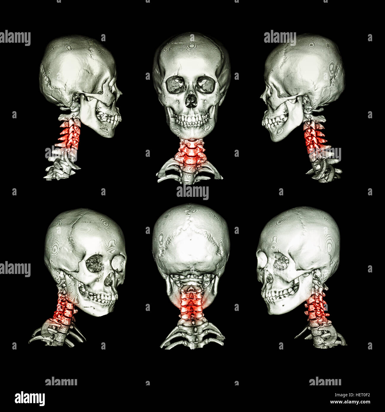 CT scan and 3D image of skull and neck . Use this image for cervical spondylosis , spondylolisthesis , spondylitis , spine trauma condition . Stock Photo