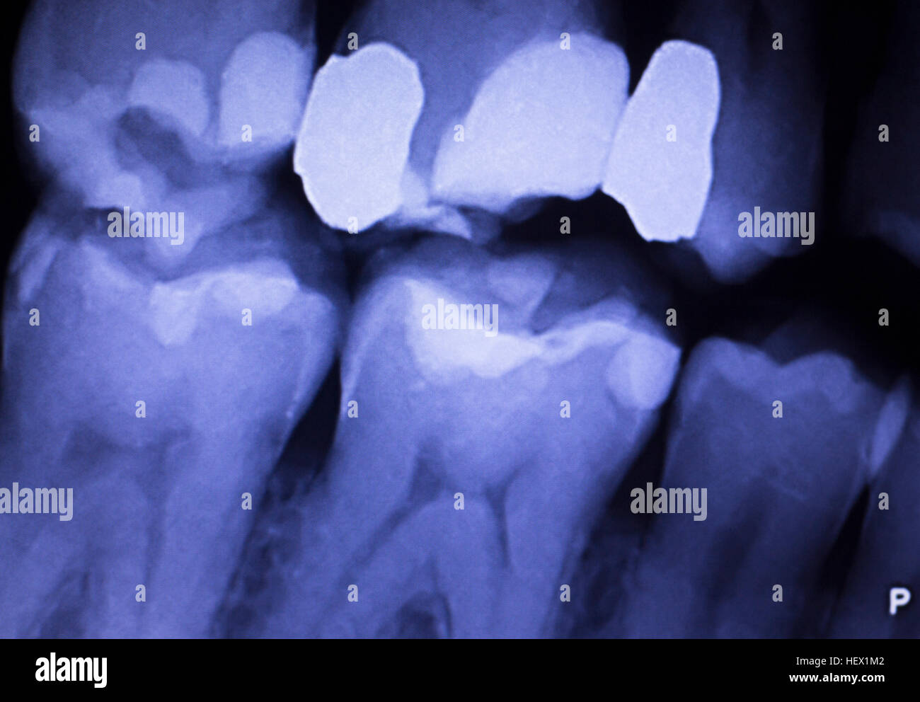 Tooth with filling dental xray closeup image showing teeth roots, gum