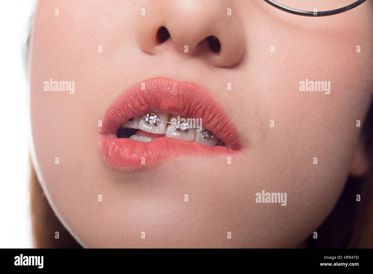 Beautiful young woman with brackets on teeth close up Stock Photo