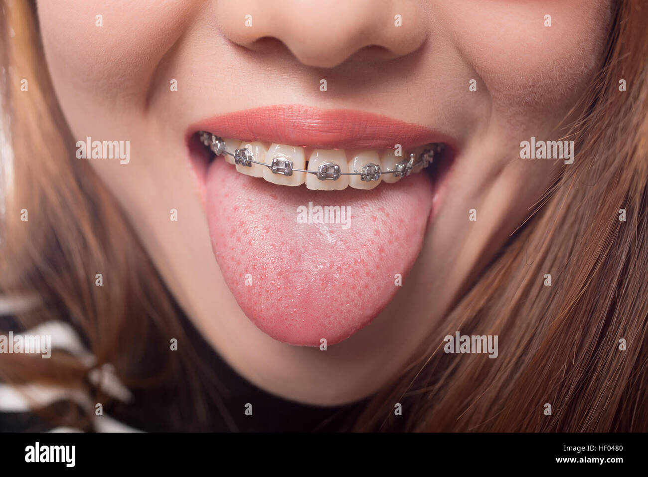 Closeup of a mouth with braces on theeth and the tongue out, isolated