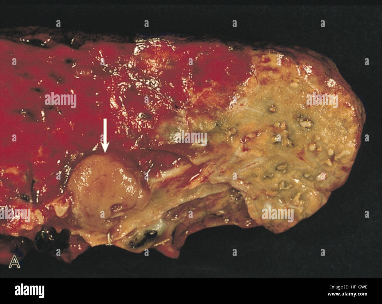 Carcinoid tumor with postobstructive pneumonia Stock Photo