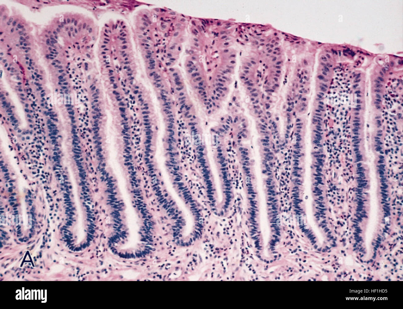 Barrett's mucosa, lowgrade dysplasia Stock Photo Alamy