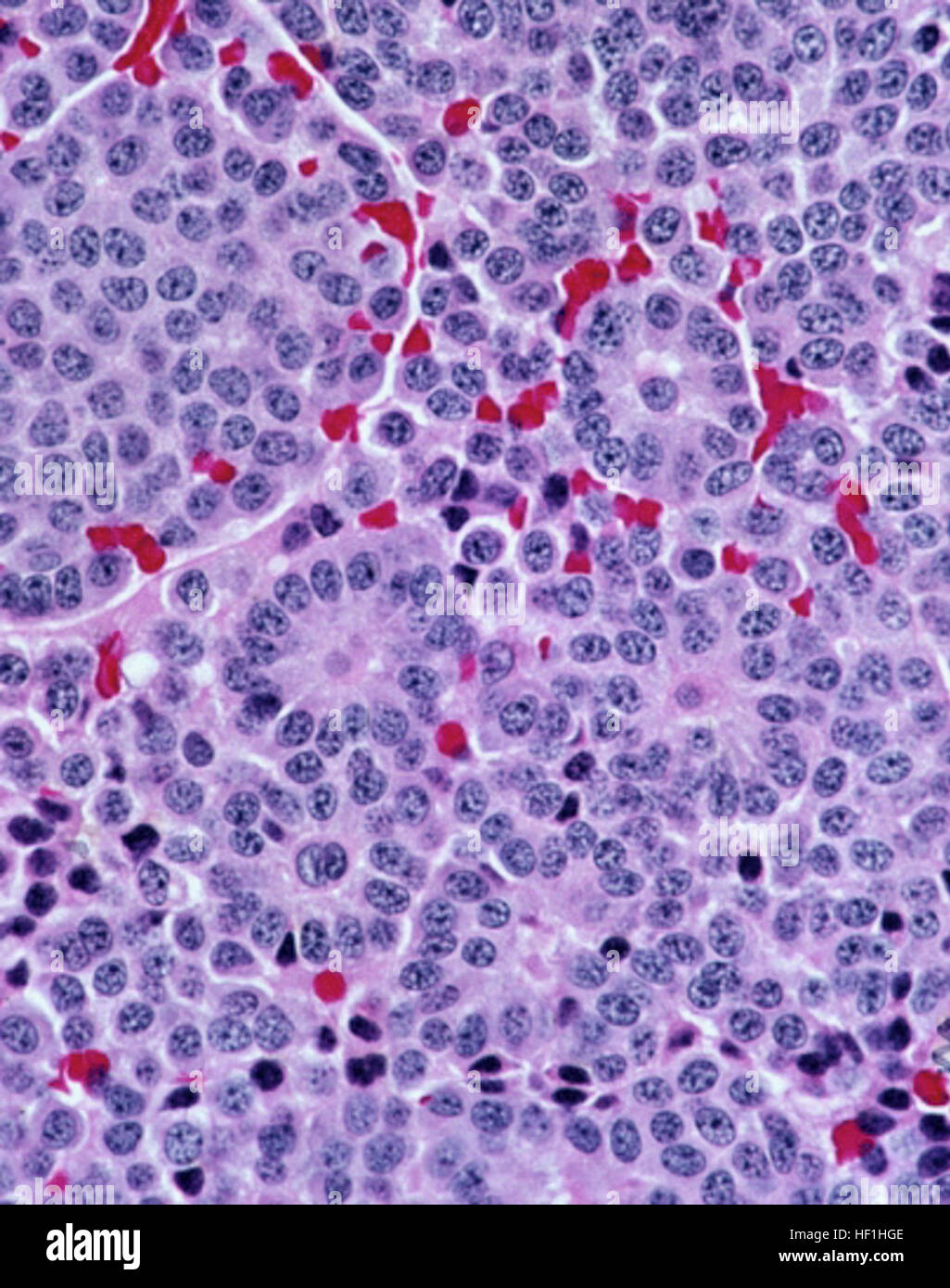 Typical carcinoid tumor of the lung, prominent rosettes Stock Photo