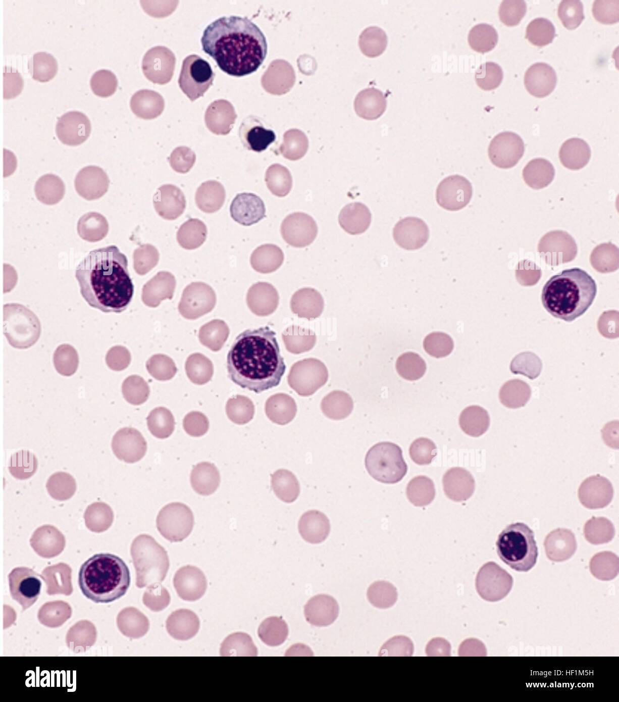 AML-M6 refers to a medical laboratory analysis, specifically a blood ...