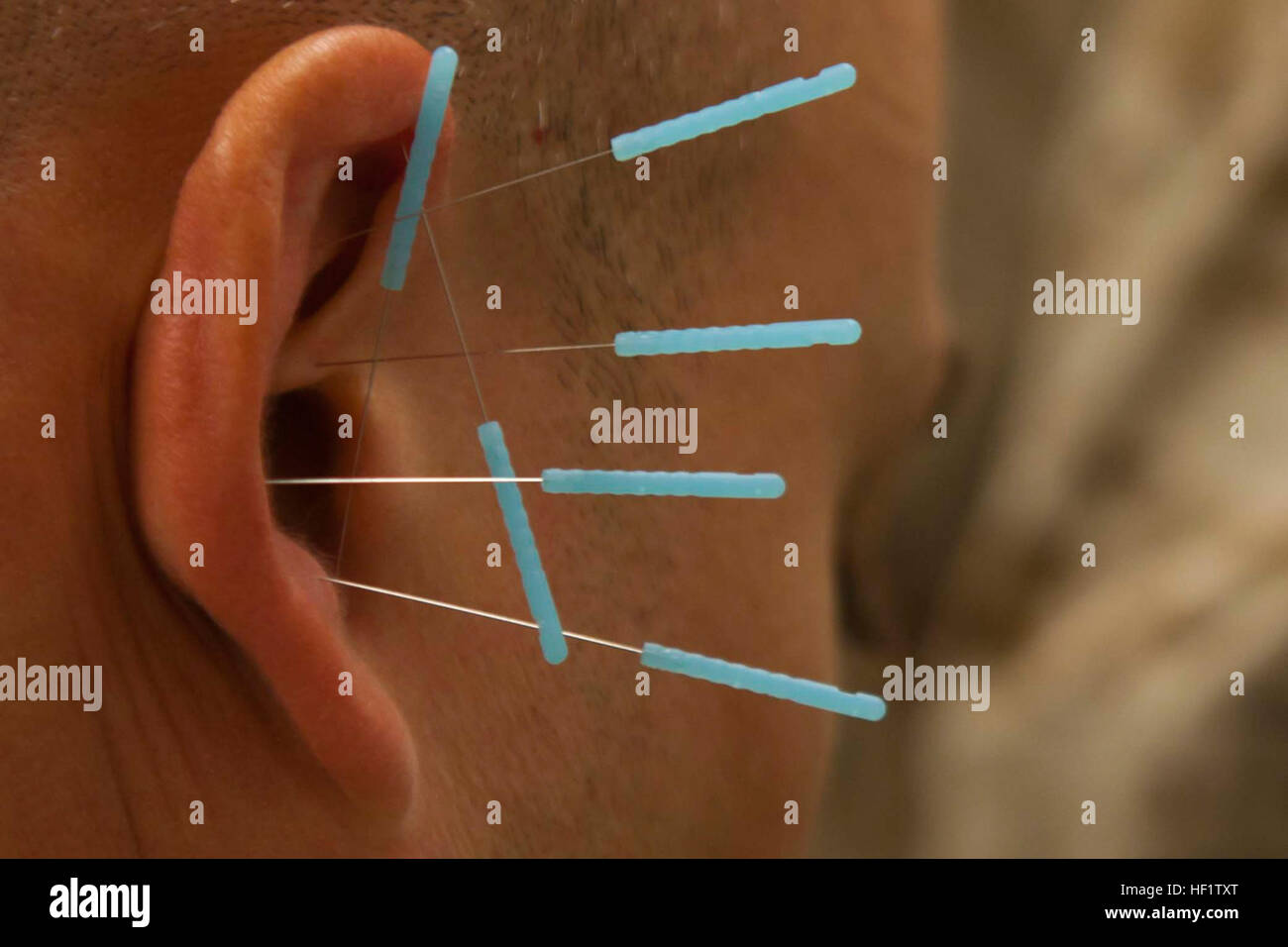 Acupuncture needles protrude from the ear of a patient at the combined aid station on Camp