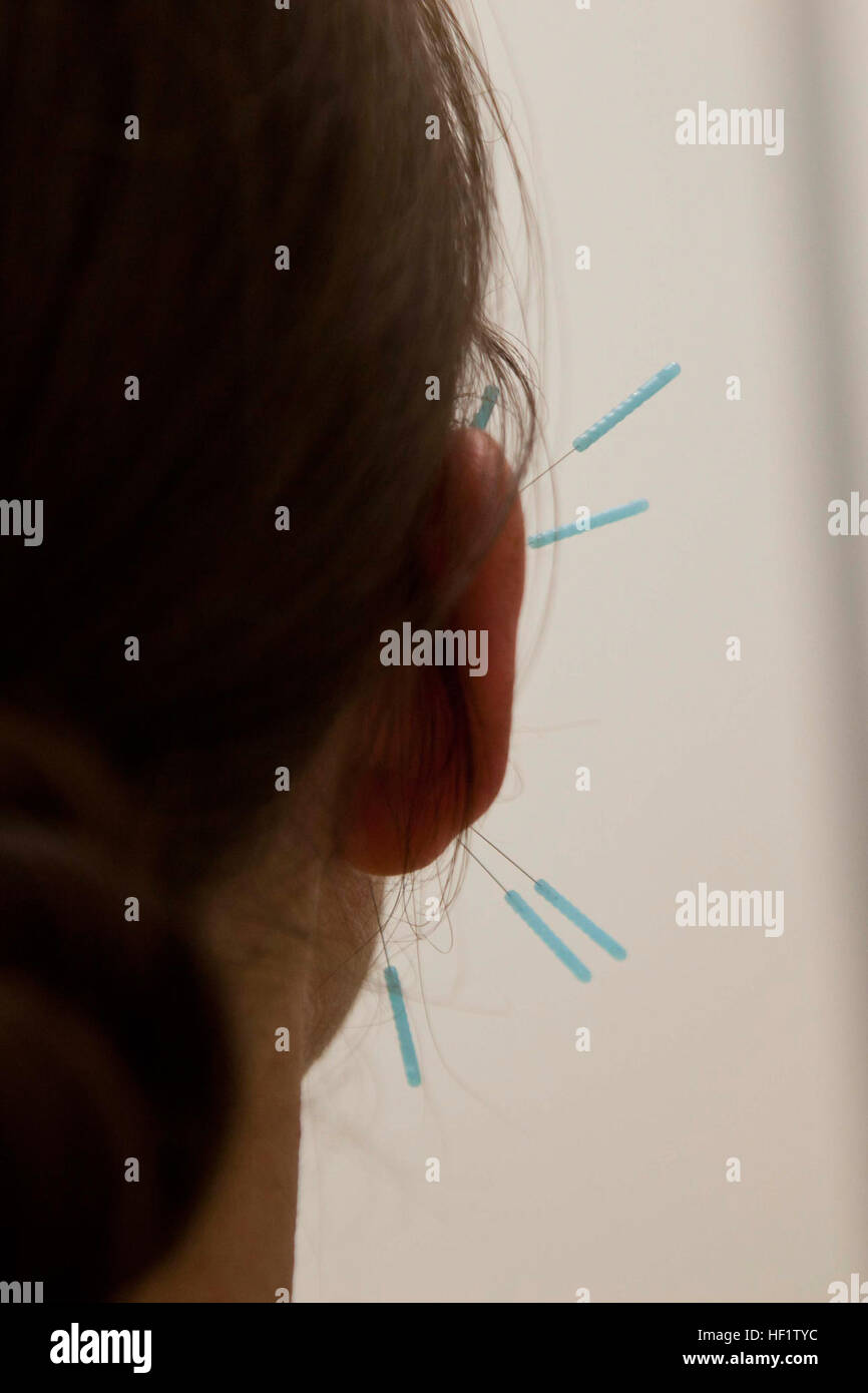 Acupuncture needles protrude from the ear of a patient at the combined