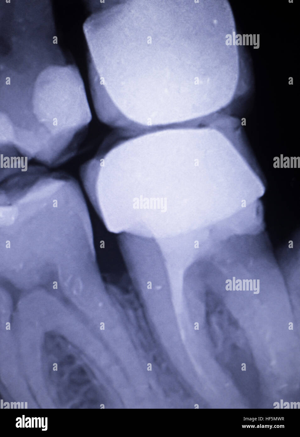 Tooth with filling dental xray closeup image showing teeth roots, gum