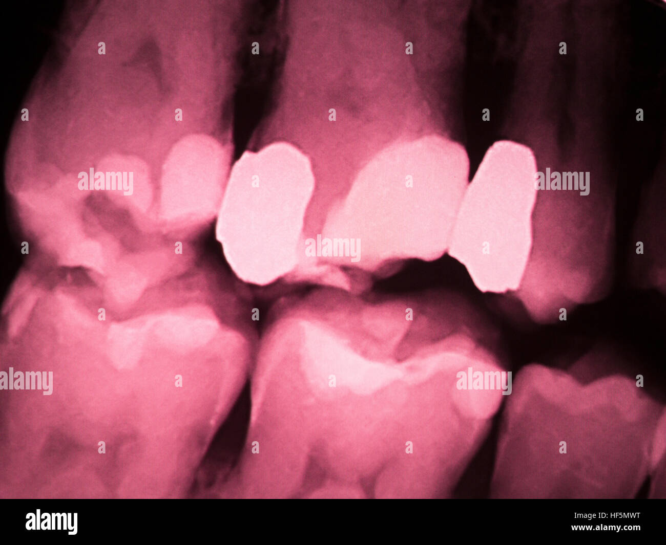 Tooth with filling dental xray closeup image showing teeth roots, gum