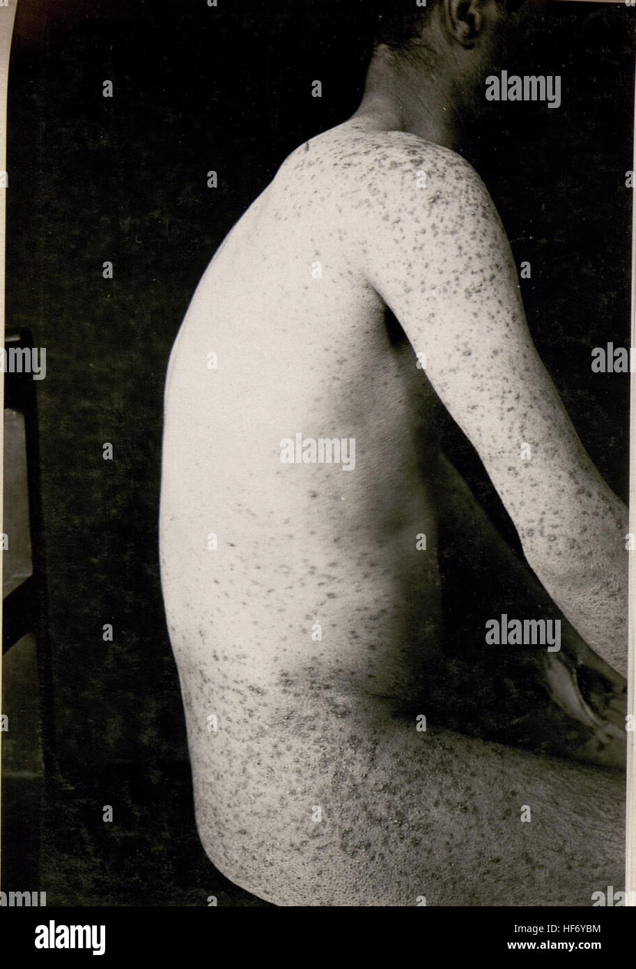 A photograph showing a Russian prisoner of war with cachectic acne ...