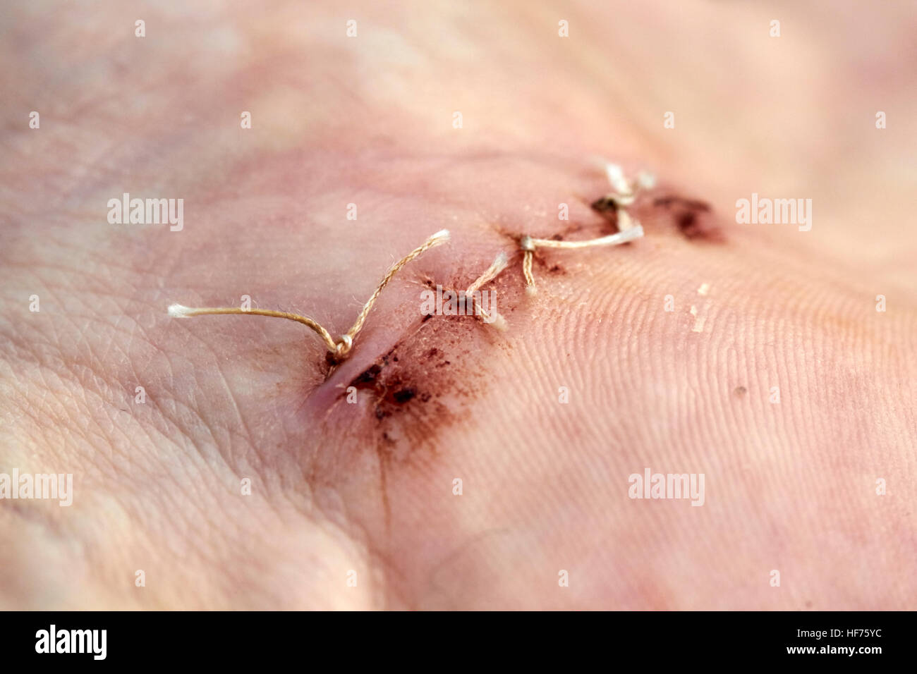 dissolvable stitches in a hand surgical wound to correct carpal tunnel syndrome Stock Photo