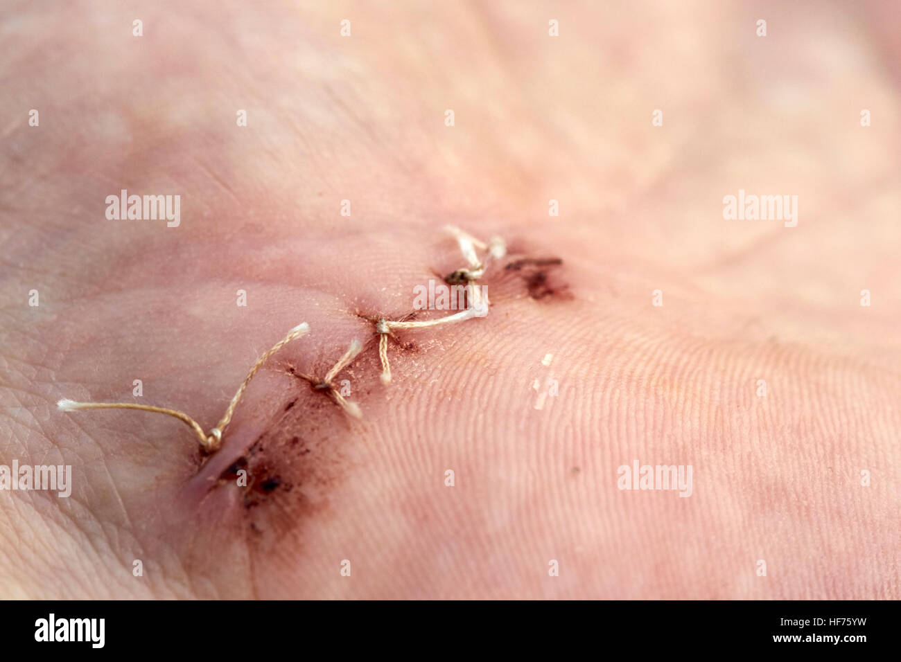 dissolvable stitches in a hand surgical wound to correct carpal tunnel syndrome Stock Photo