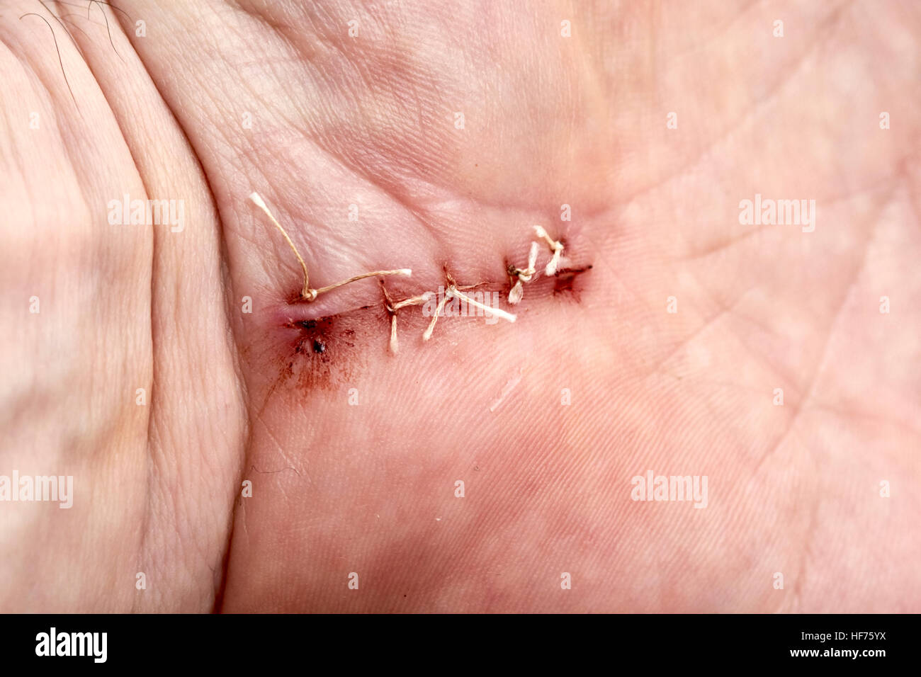 dissolvable stitches in a hand surgical wound to correct carpal tunnel syndrome Stock Photo