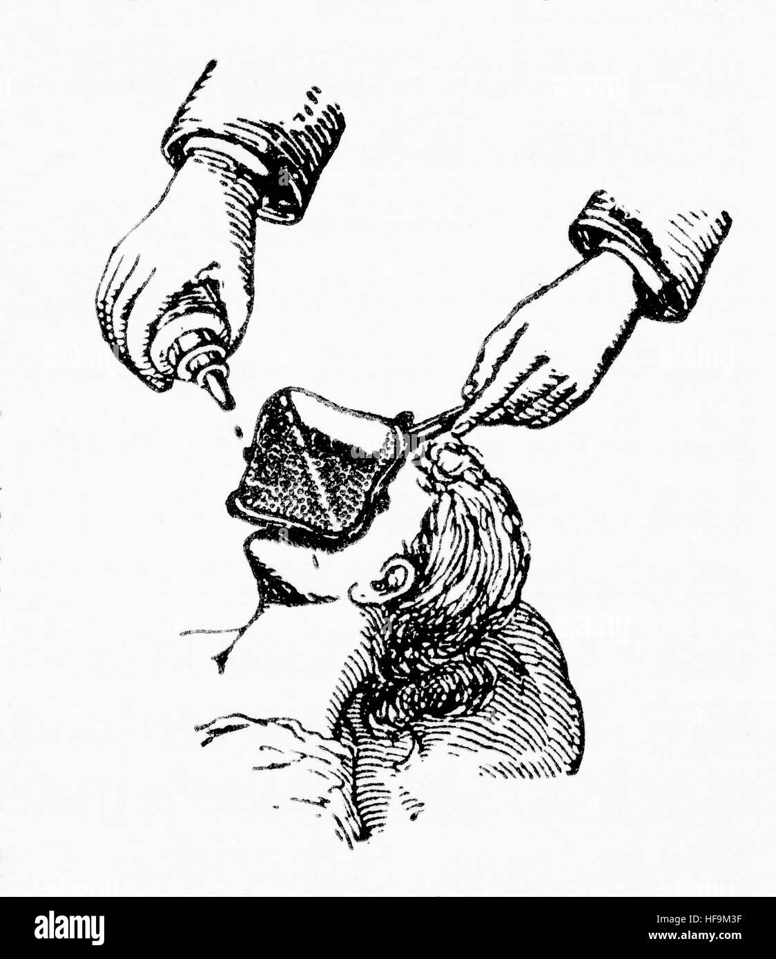 Anaesthetizing a patient in the late 19th century by dripping chloroform onto a mask placed over the face.  From Meyers Lexicon, published 1924. Stock Photo
