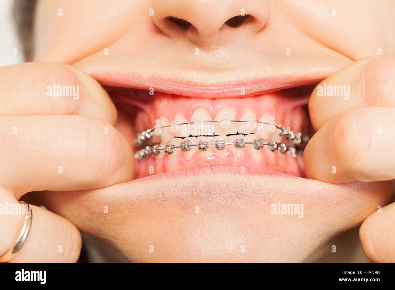 Metal braces hires stock photography and images Alamy