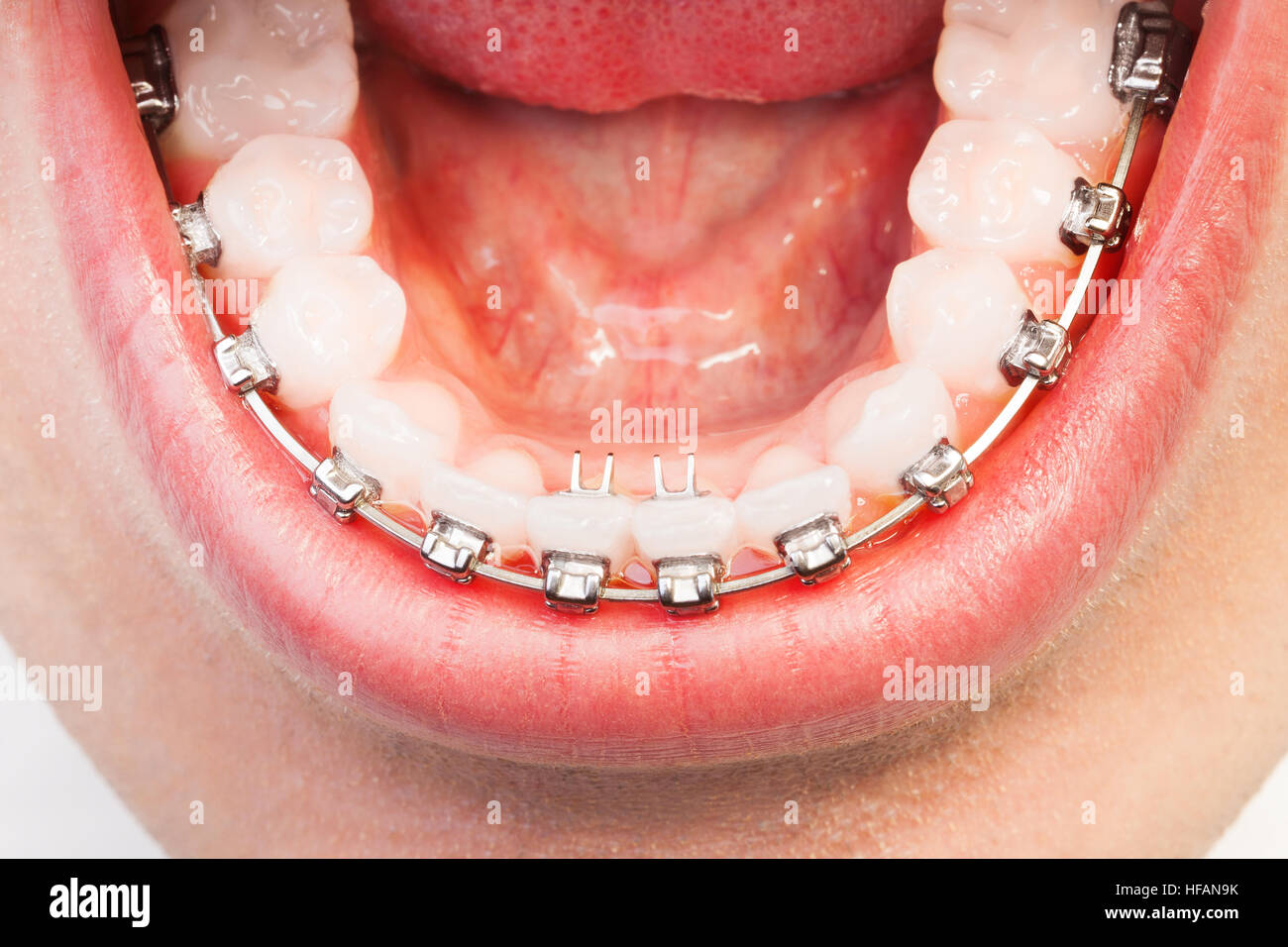 Braces on teeth hires stock photography and images Alamy