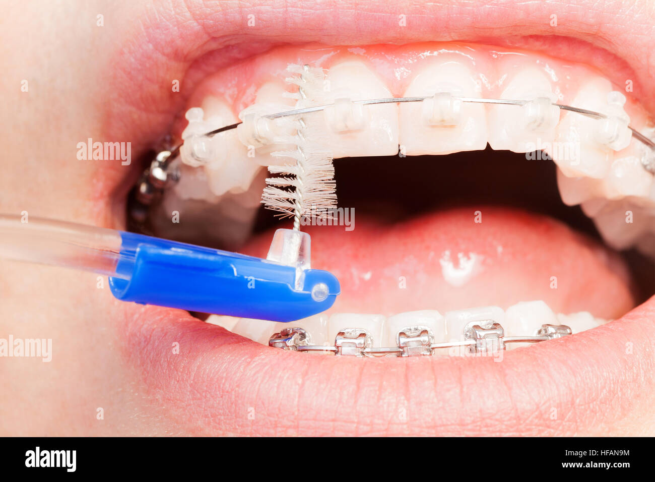 Orthodontic Interdental Brushes At Don Casteel Blog