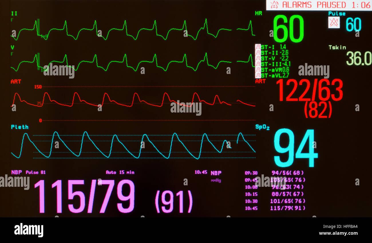 Monitor showing ECG with paced heart rhythm, arterial blood pressure, oxygen saturation and noninvasive blood pressure. Stock Photo