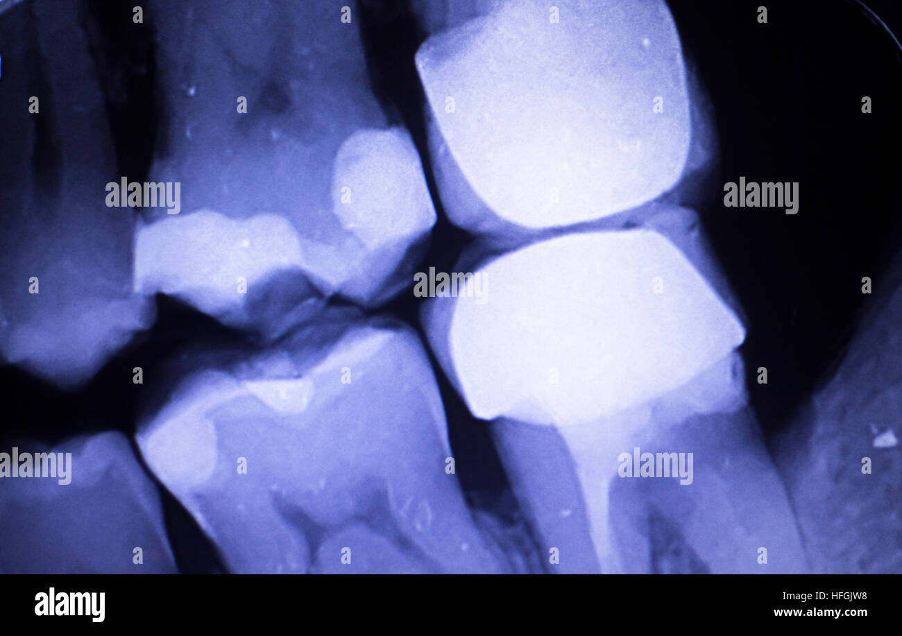 Tooth with filling dental x-ray close-up image showing teeth roots, gum ...