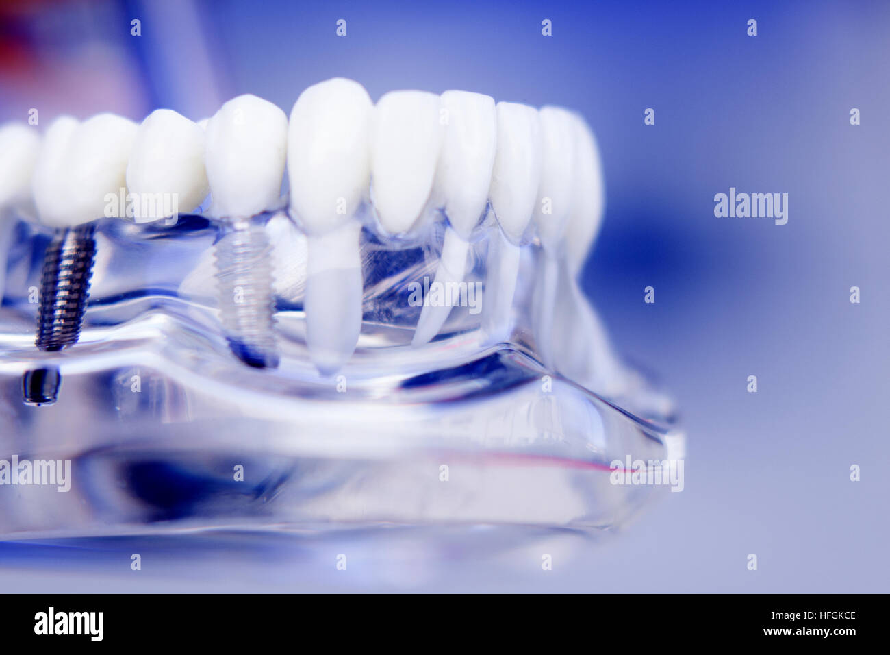 Teeth mould hi-res stock photography and images - Alamy