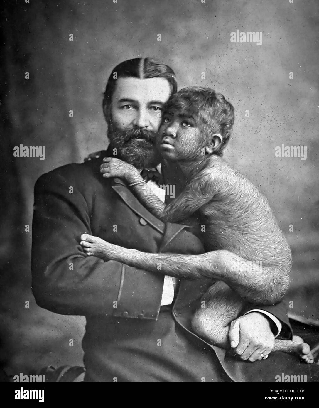 Hypertrichosis Black and White Stock Photos & Images - Alamy