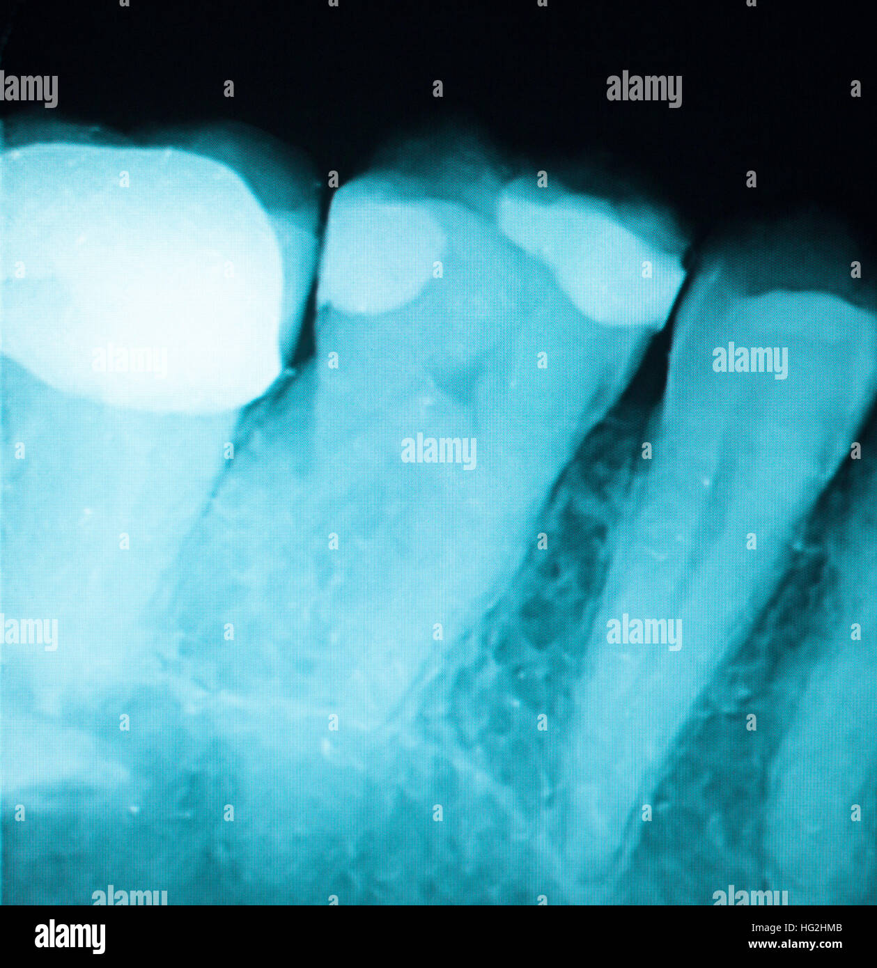 Tooth with filling dental xray closeup image showing teeth roots, gum