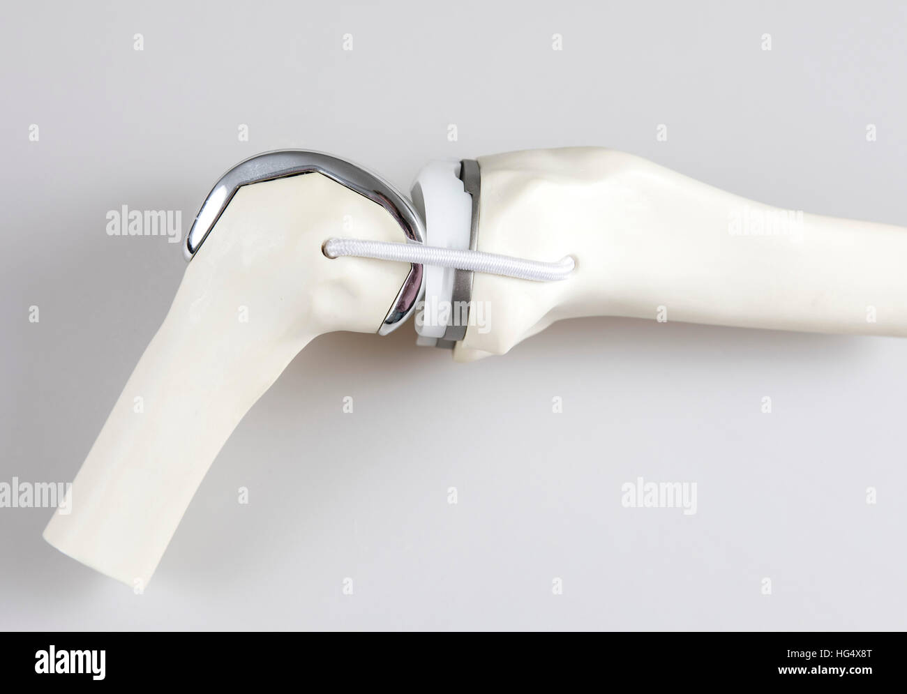 Knee prosthesis, knee endoprosthesis or knee joint prosthesis, on a