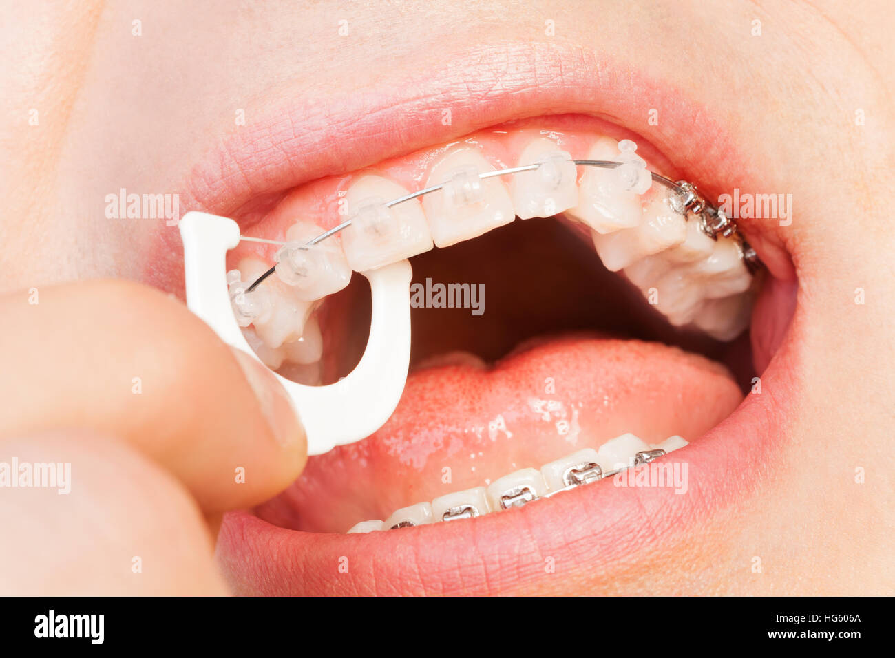 Man with braces using floss for upper jaw hygiene Stock Photo