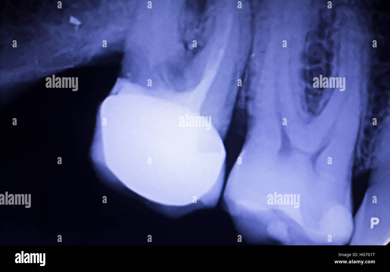 Tooth with filling dental xray closeup image showing teeth roots, gum