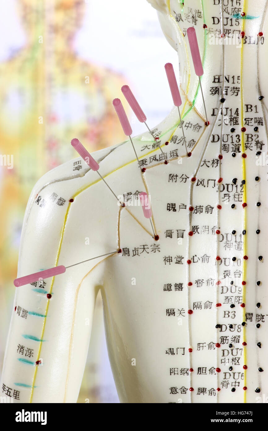 female acupuncture model with needles in the shoulder Stock Photo Alamy