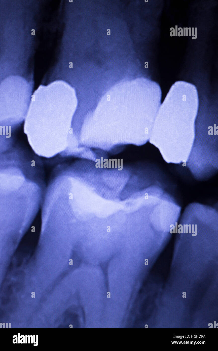 Tooth with filling dental xray closeup image showing teeth roots, gum