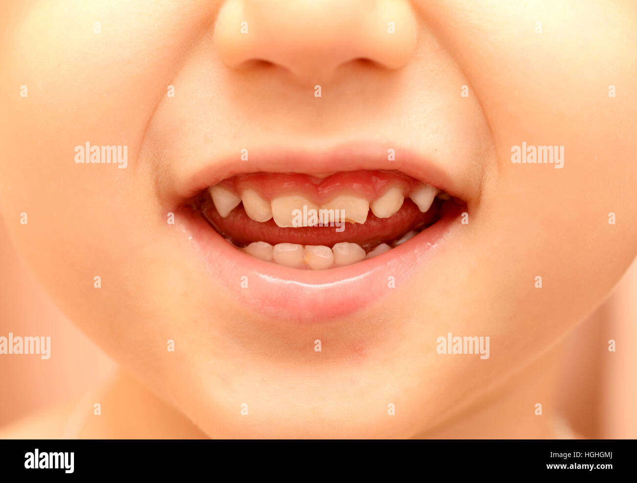 Rotten Teeth Child High Resolution Stock Photography and Images Alamy