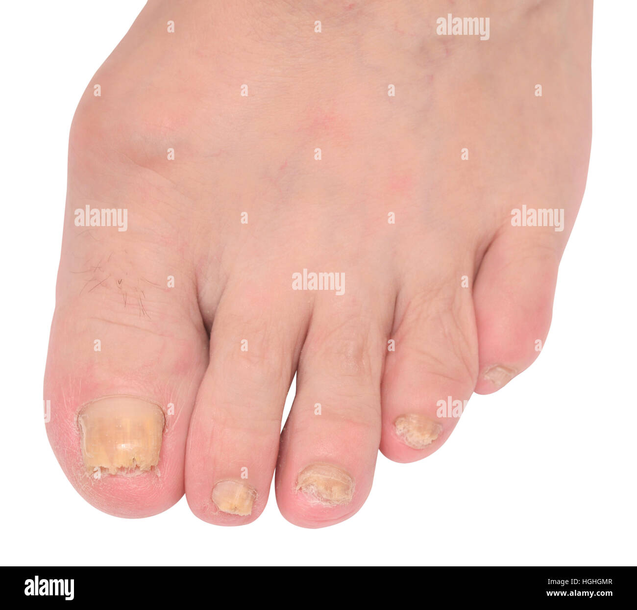 Discover 132+ oral antifungal for nail fungus super hot
