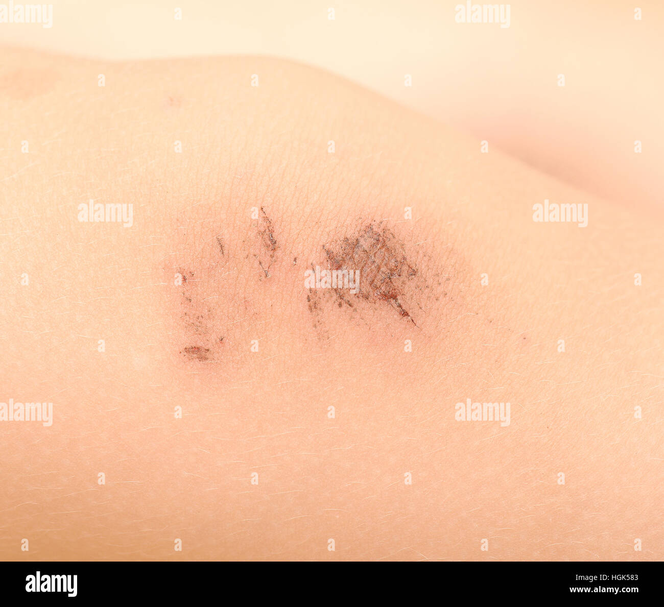 Girl with scraped knee hires stock photography and images Alamy