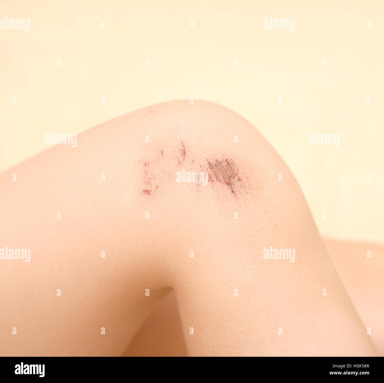 Bruise hires stock photography and images  Page 3  Alamy