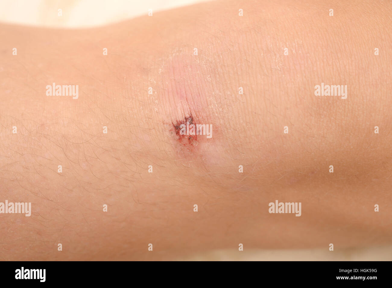 Scraped knee hires stock photography and images Alamy
