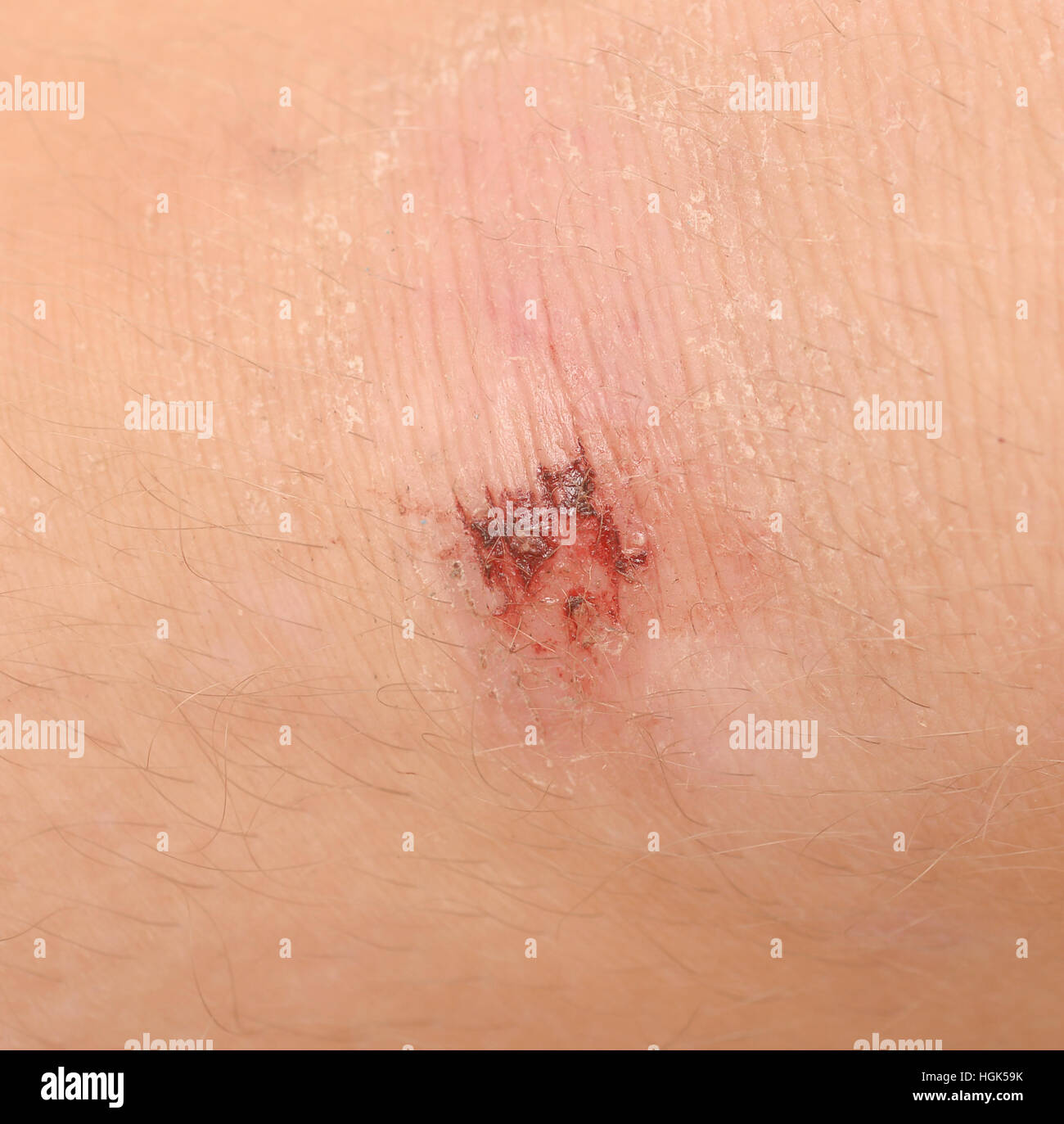 Scraped knee hires stock photography and images Alamy