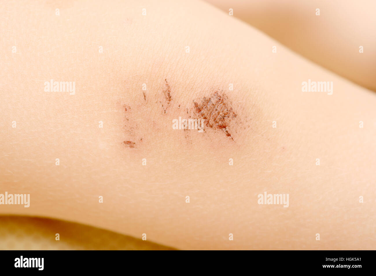 Scraped knees of a little childl on white Stock Photo Alamy