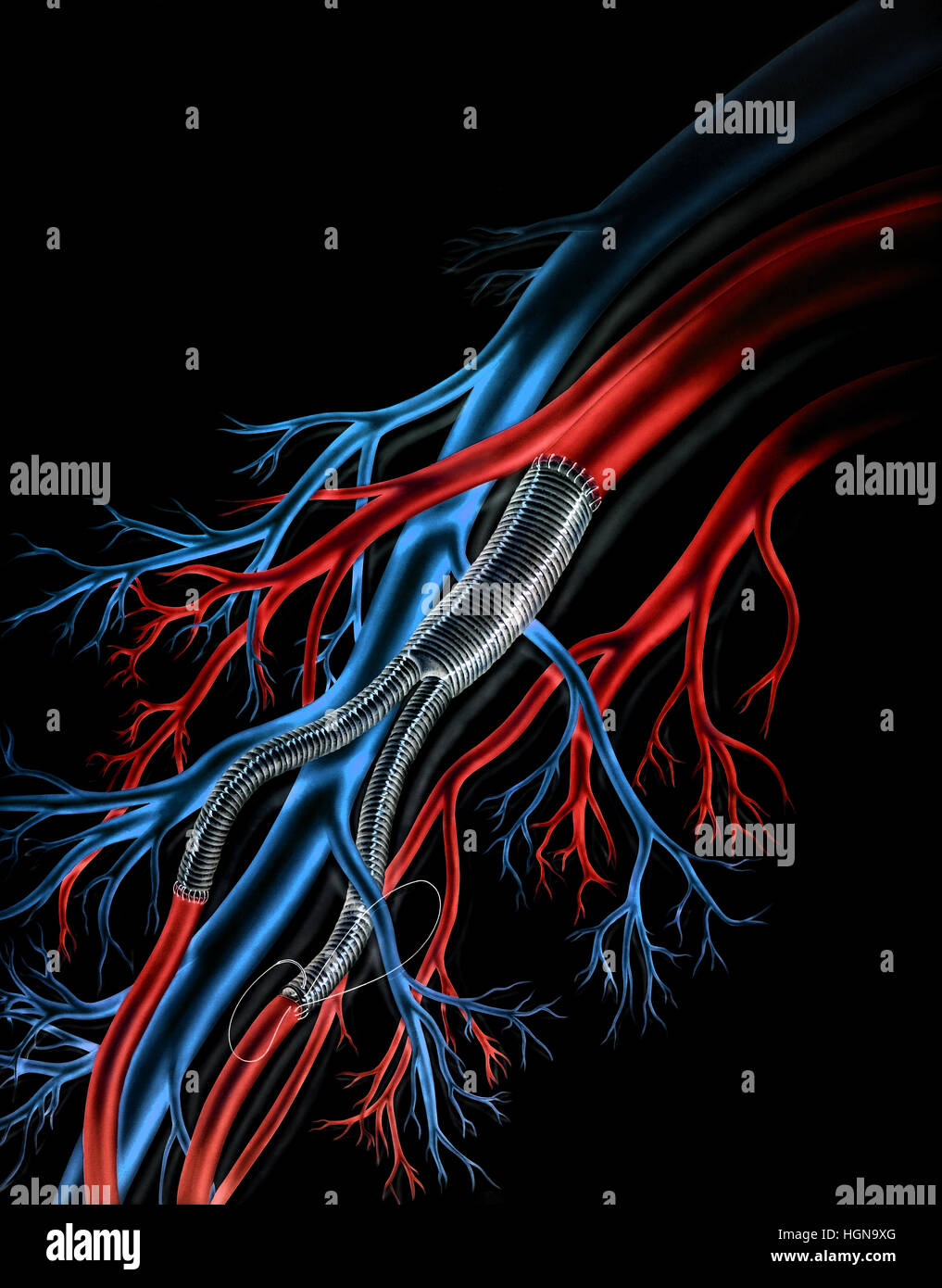 Lungs Teflon Arterial Grafts shown on black background Stock Photo