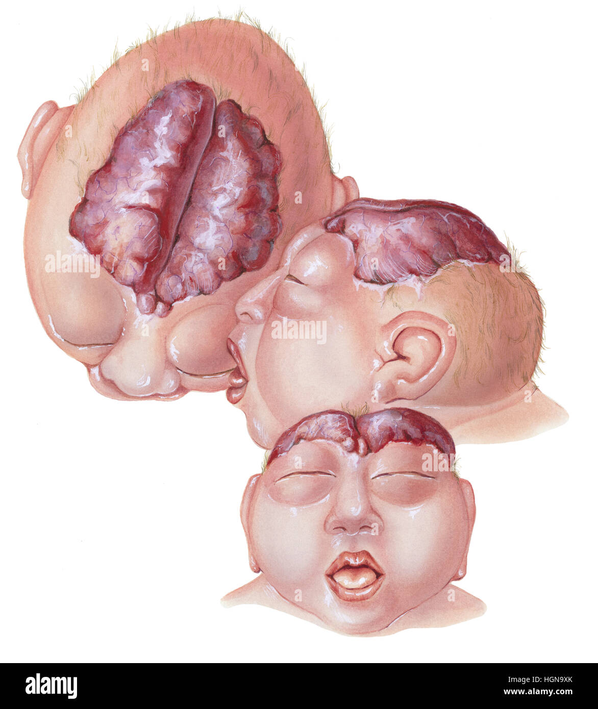 A newborn baby with anencephaly showing the brain protruding through the skull from three views Stock Photo