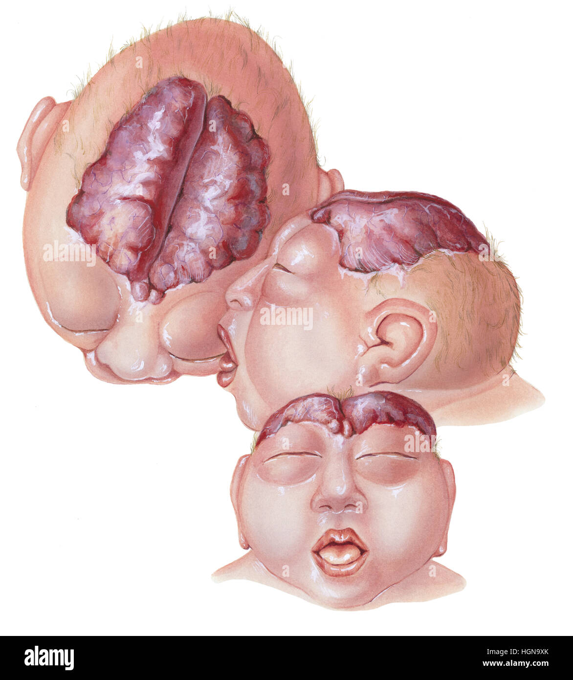 half human half frog anecephalic baby